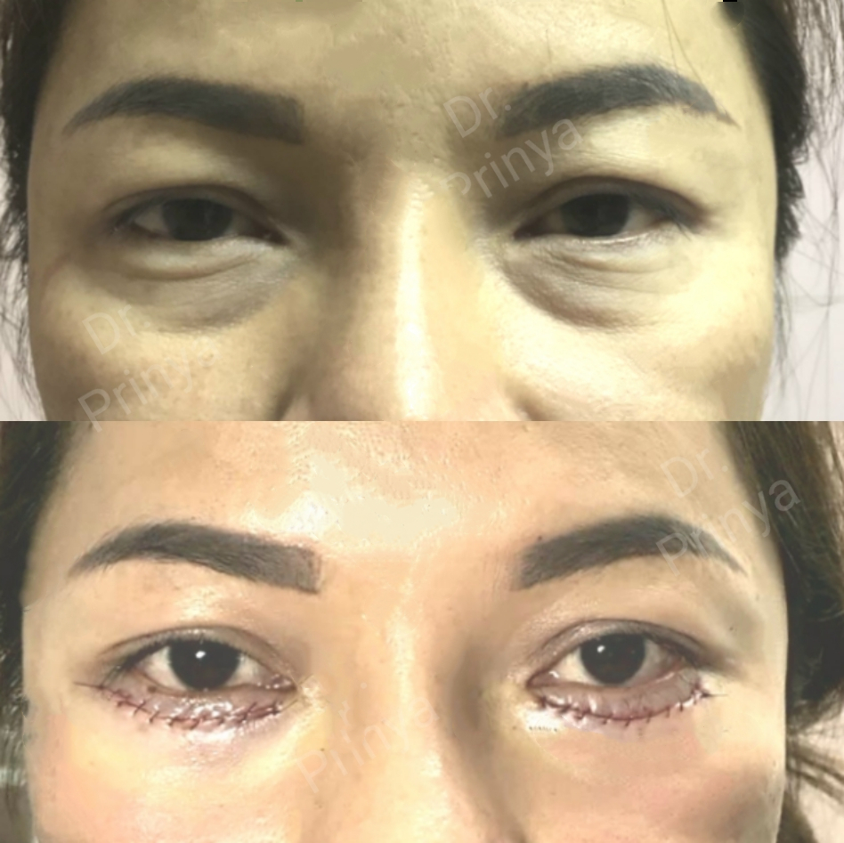 eyelid laser